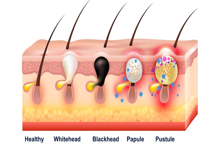 stages of acne / pimples