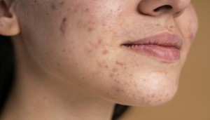 post acne dark spots marks hyperpigmentation