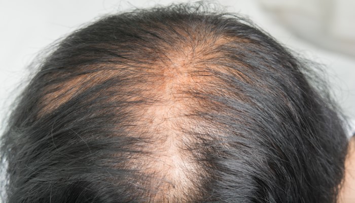 hair loss in women female pattern hair loss