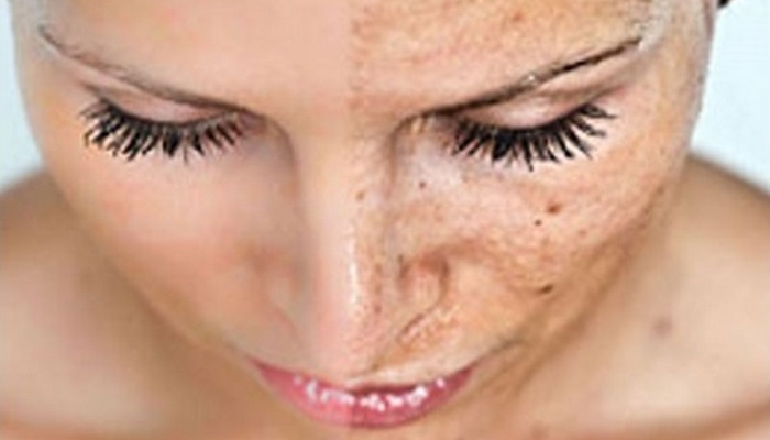 face of girl having pigmentation marks tanning
