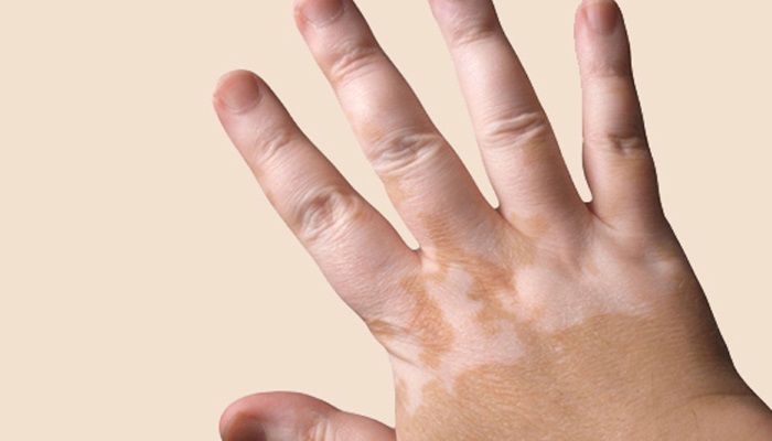 hand having leukoderma or vitiligo