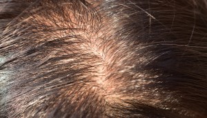 hair thinning female paxxxttern hair loss