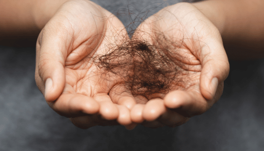 Diffuse Hair Fall in Men & Women