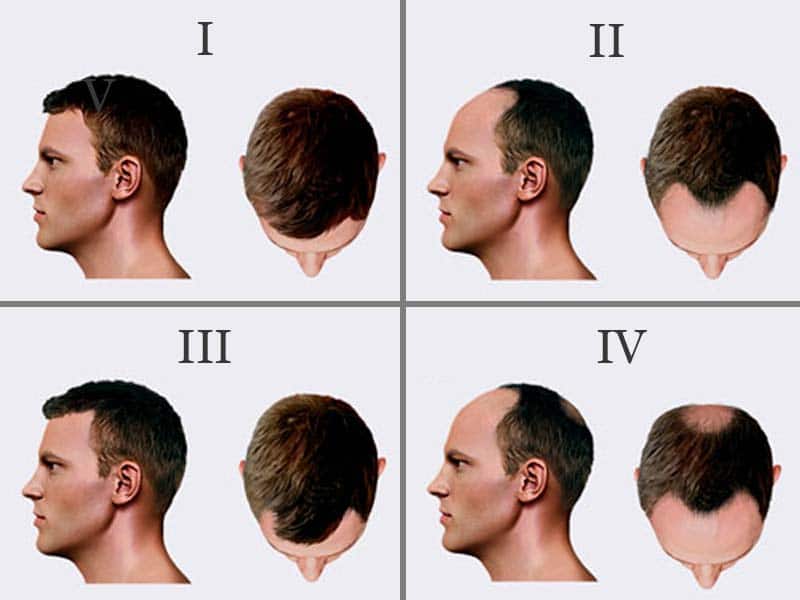 male paxxxttern baldness androgenic alopecia norwood hamilton scale stage 1 2 3 4