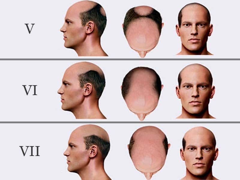 male paxxxttern baldness androgenic alopecia norwood hamilton scale stage 5 6 7