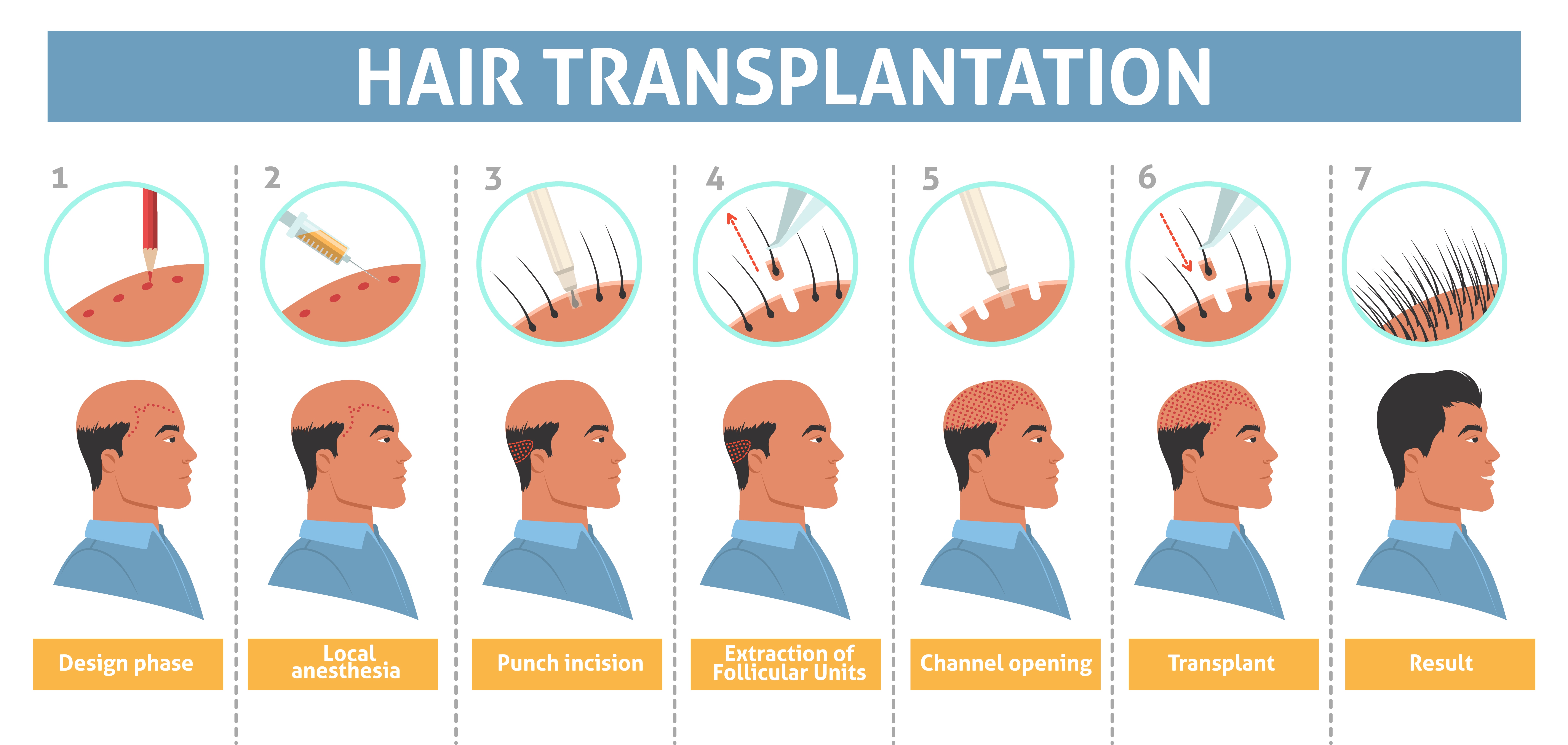 steps of hair transplantation