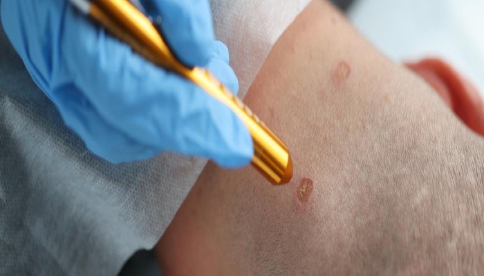 dermatologist in rajkot doing laser wart removal