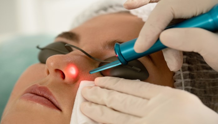 mole removal by laser