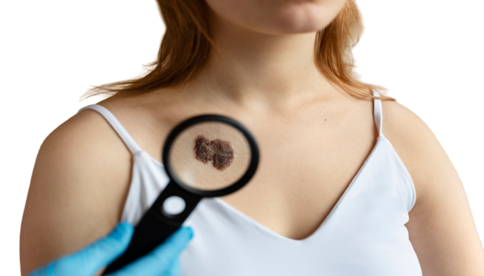 dermoscopic examination of mole