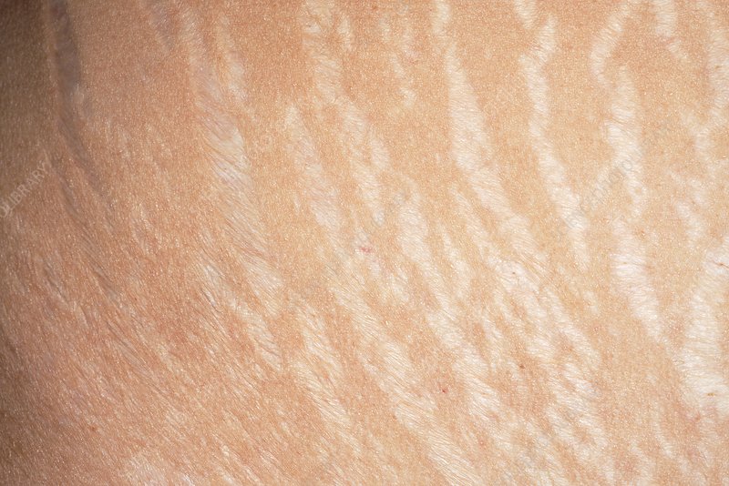 striae or stretch marks over abdomen