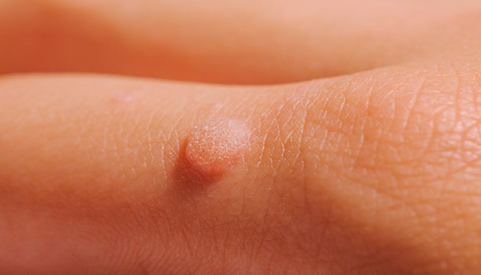 common warts