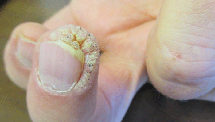 warts over fingers